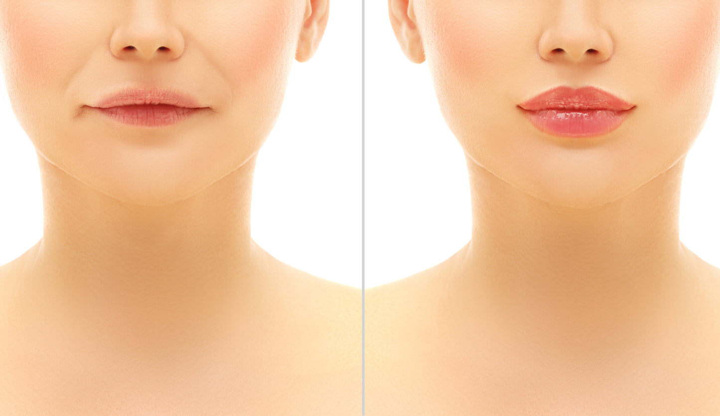Fillers Utbildning  Advanced